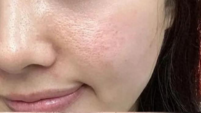 皮肤毛孔粗大怎么护肤？