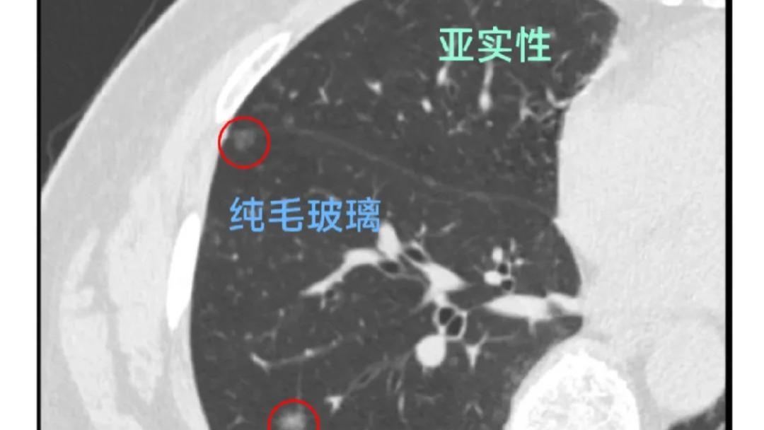 得了肺结节怎么办？先别慌，看看中美指南都怎么说！