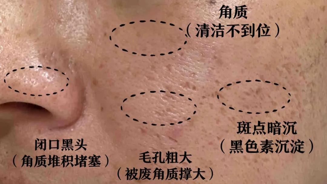 秋冬季节如何护肤？解决毛孔粗大等皮肤问题，从这些方法开始！