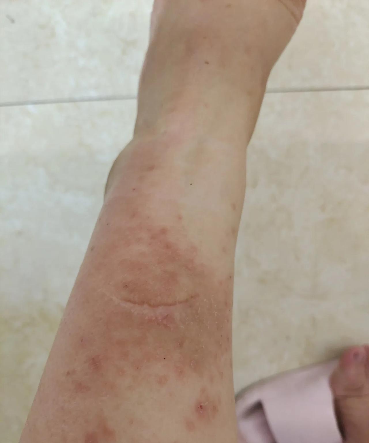 我这个脚真的没得救了，受伤的地方是10多年前了，但是每到夏天的时候，就奇痒无比，