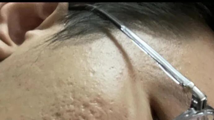 祛痘，祛痘印有好方法应对