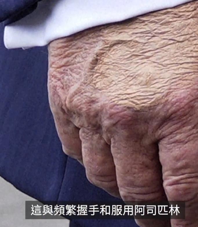 白宫于周四（7月17日）宣布，特朗普患有慢性静脉疾病。 此前几天，有关特朗普手部