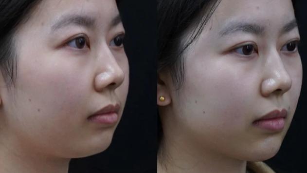 短下巴星人必看！玻尿酸丰下巴实录，侧颜杀即刻呈现！