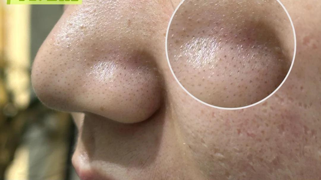 油光满面黑头多？3步急救敏感肌毛孔粗大