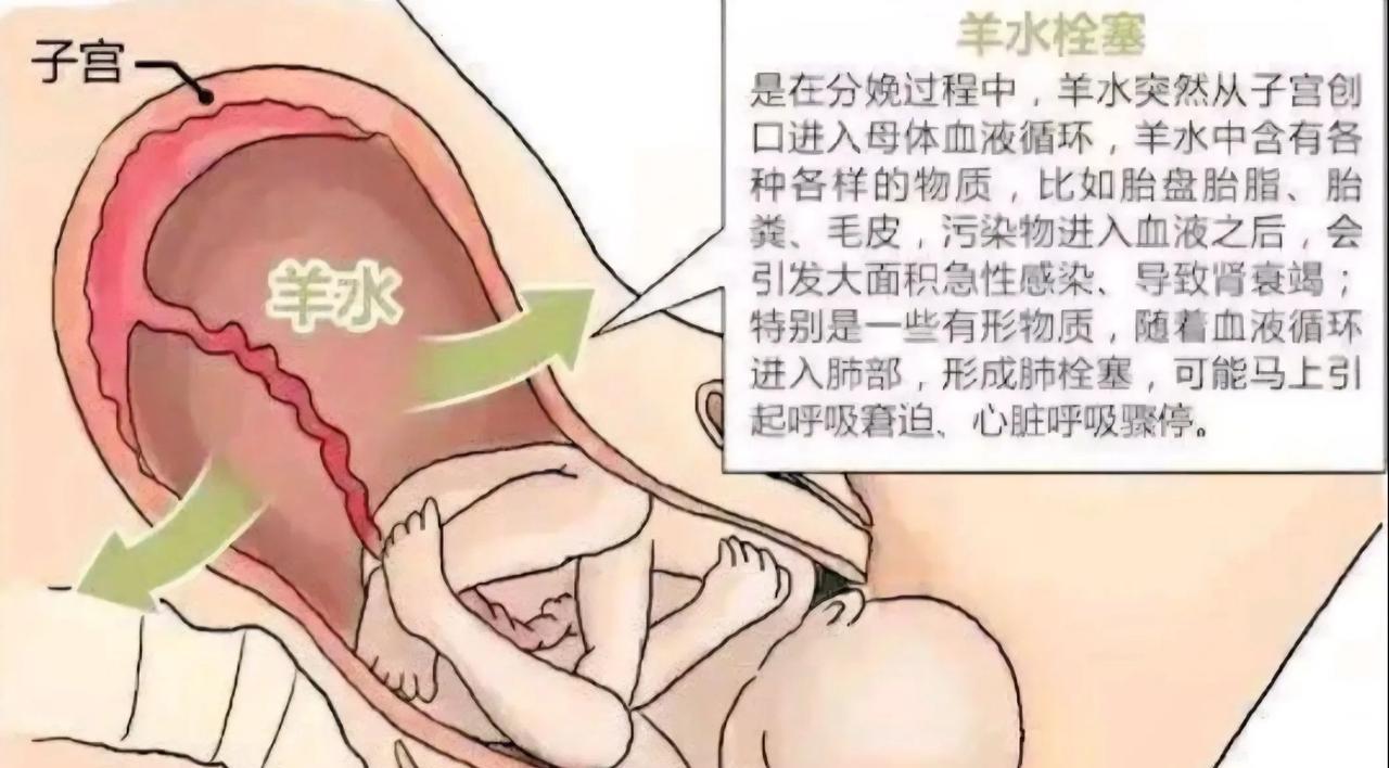 看到一条消息，河南周口一位妇产科医生因为救活一位羊水栓塞的产妇被网暴7个月而选择
