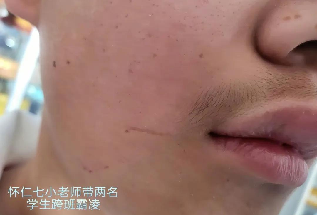 “太可怕了，山西一老师带学生跨班霸凌！”一个小学男孩如今晚上睡觉老喊“我不敢了”
