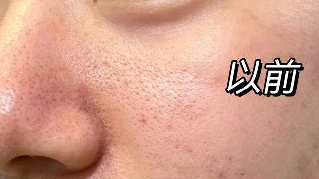毛孔粗大怎么办？清洁、缩孔、修复三步，轻松改善毛孔粗大问题！