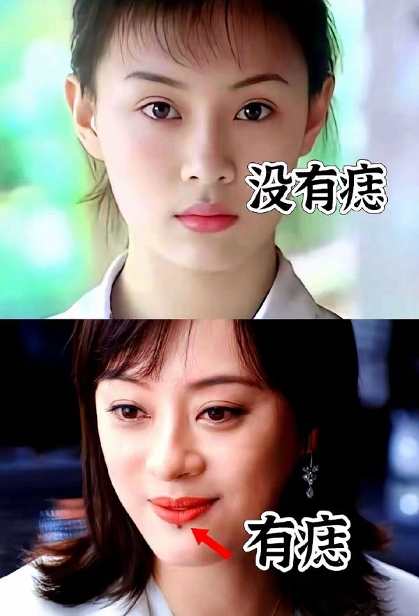 原来孙俪嘴角的不是痣，
而是车祸受伤的疤！
孙俪说：“这玻璃在我体内藏了10年！