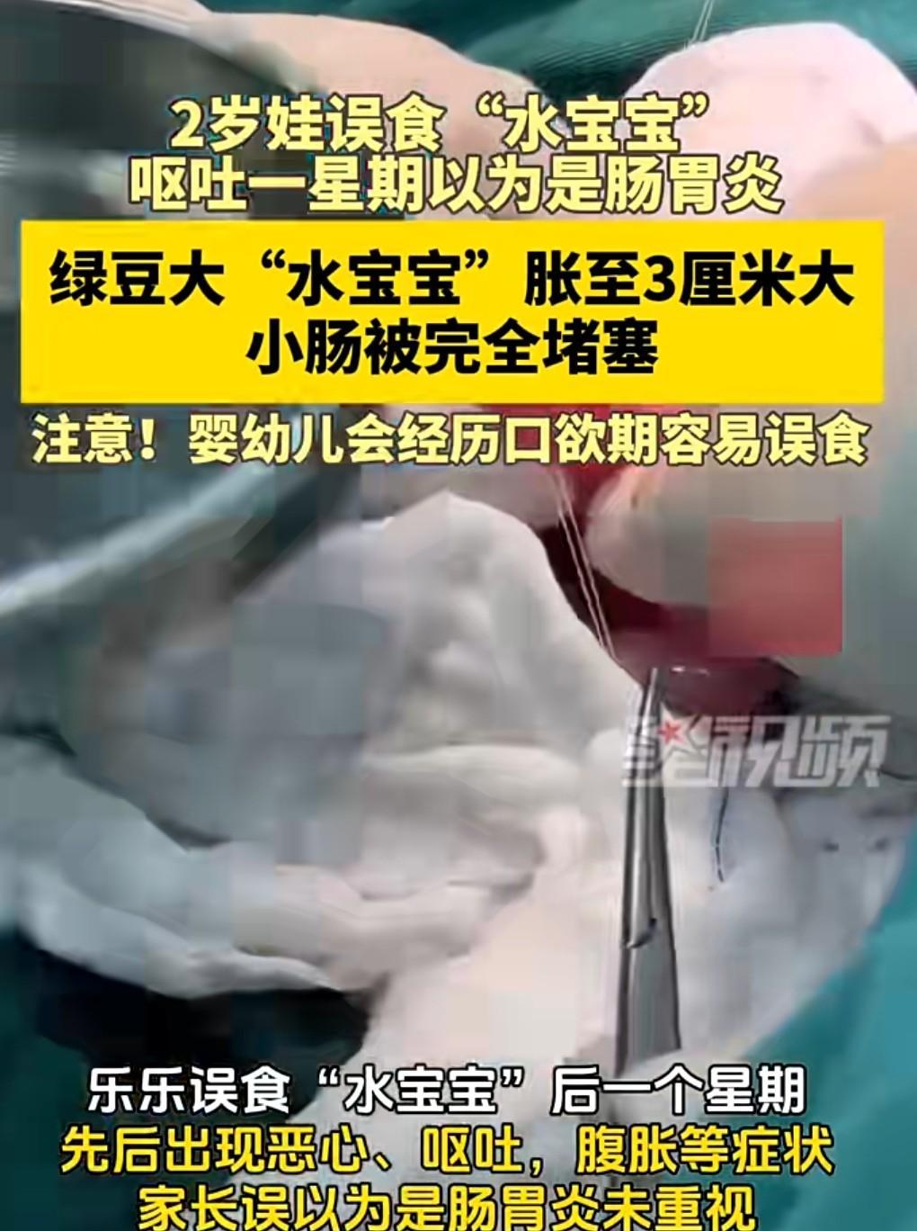这真是敲响警钟啊。
千万不要给幼小的儿童买水宝宝、磁力珠这样的玩具。
近日，一名