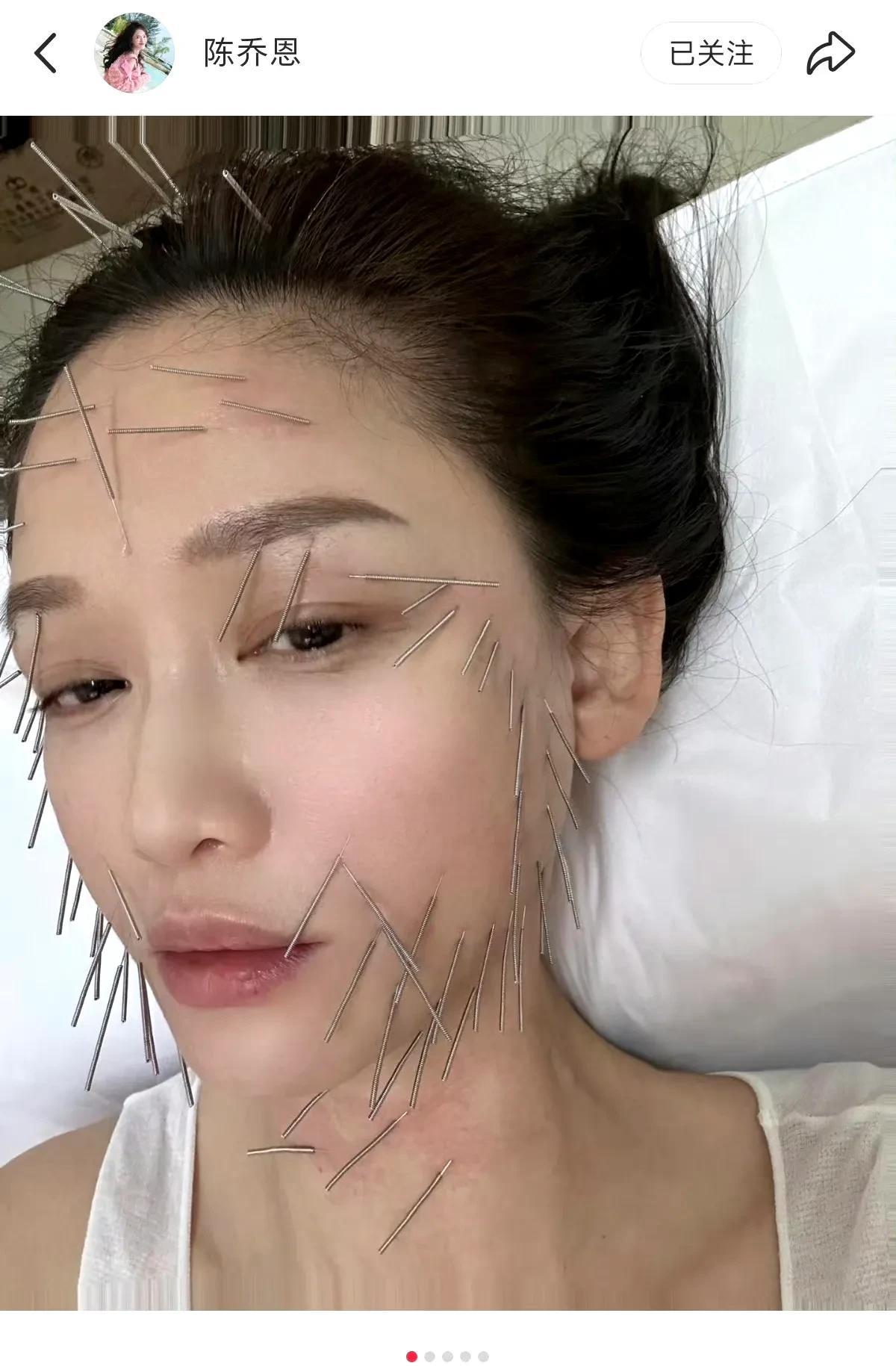 陈乔恩和网友大方分享自己的保养～～针雕，光看就觉得疼。好奇扎完不会有针眼吗？女明