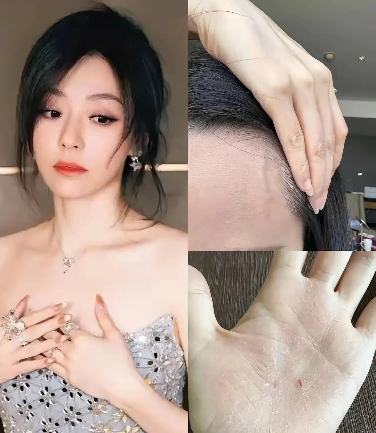 张靓颖又好好地给我们提了个醒
不管你多有钱，不管你多漂亮，身体出现问题就麻烦了，
