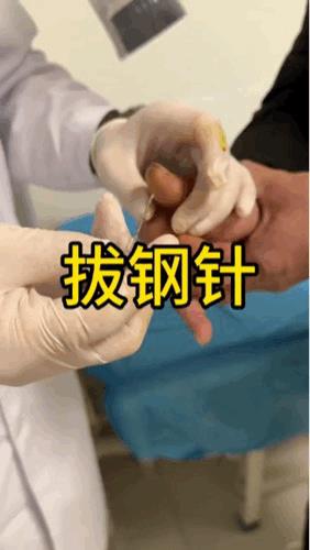 要不怎么说骨科都是一帮子技工师傅呢[捂脸]