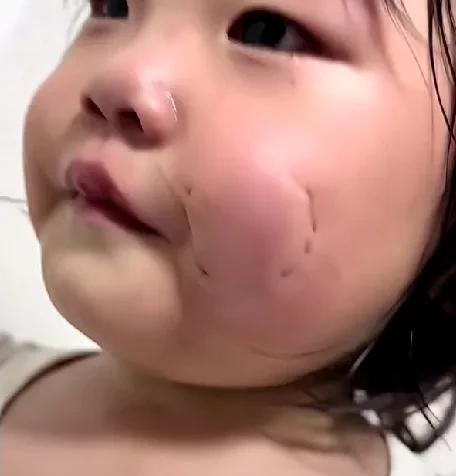 小宝把姐姐咬成这样了，得多疼！但是问了妹妹还不承认！真的得打[发怒]