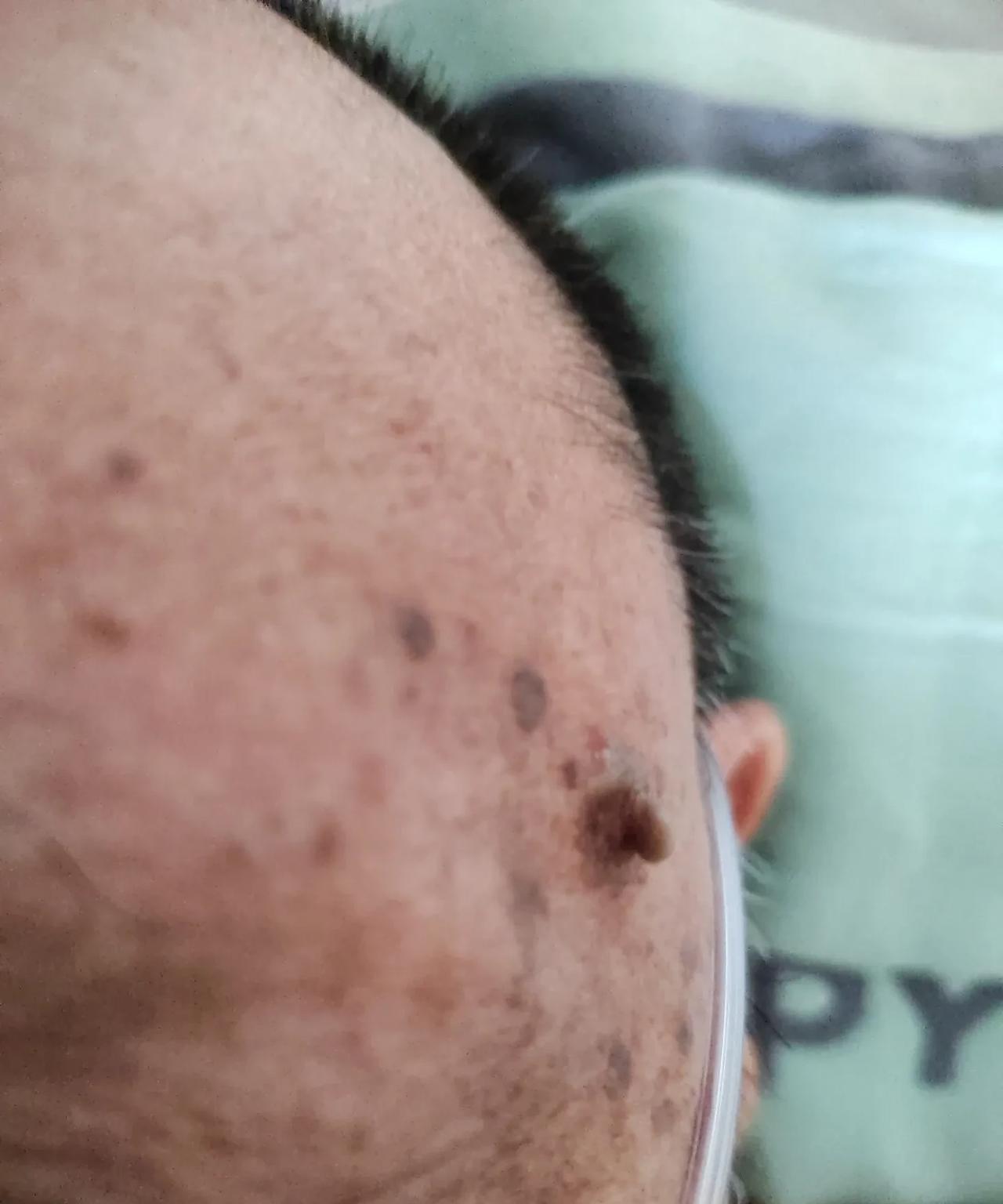 我家老爷子左边脸太阳穴附近长了个大肉疣，不痛不痒的，就是对容貌有影响。他成天叫嚷