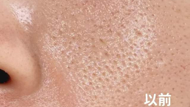 毛孔粗大怎么办？7个秘籍小技巧让你毛孔隐形！