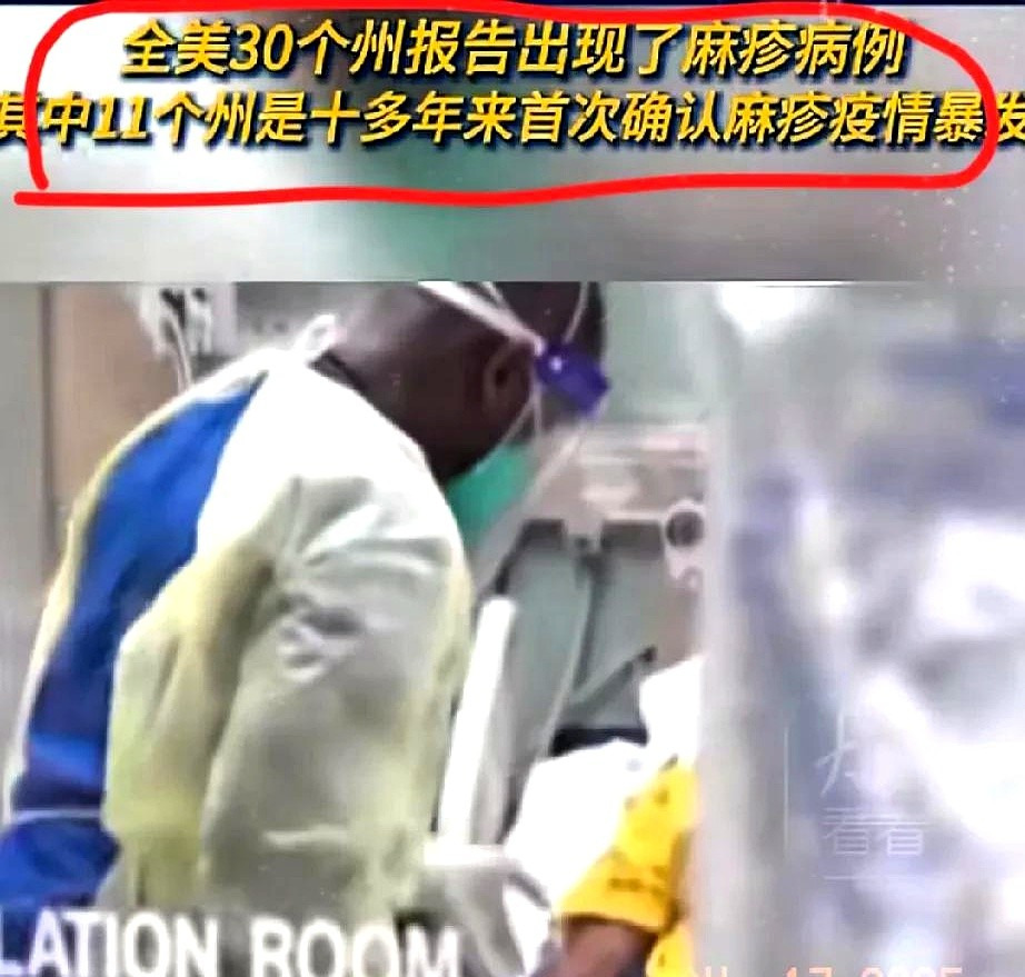 美国麻疹大爆发 疫苗别不打











天呐！美国这是咋了？麻疹像疯了