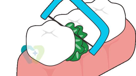 牙线会让牙缝变大？这个「黑锅」牙线不背