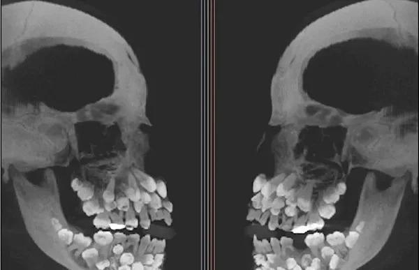 巴西11岁女孩口中惊现81颗牙齿，远超正常人28-32颗恒牙，震惊医学界。牙医通