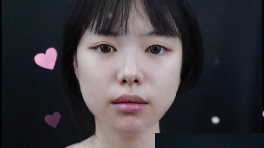 如何拥有完美下颌线？张敬花案例：玻尿酸打造高级轮廓线！