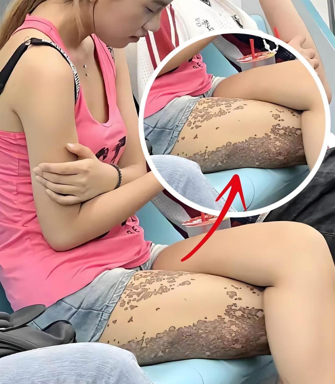 本想搭讪捷运美女，却被她腿上的「蛇皮斑」吓退！PO上网后网友炸锅：快跑，会传染！
