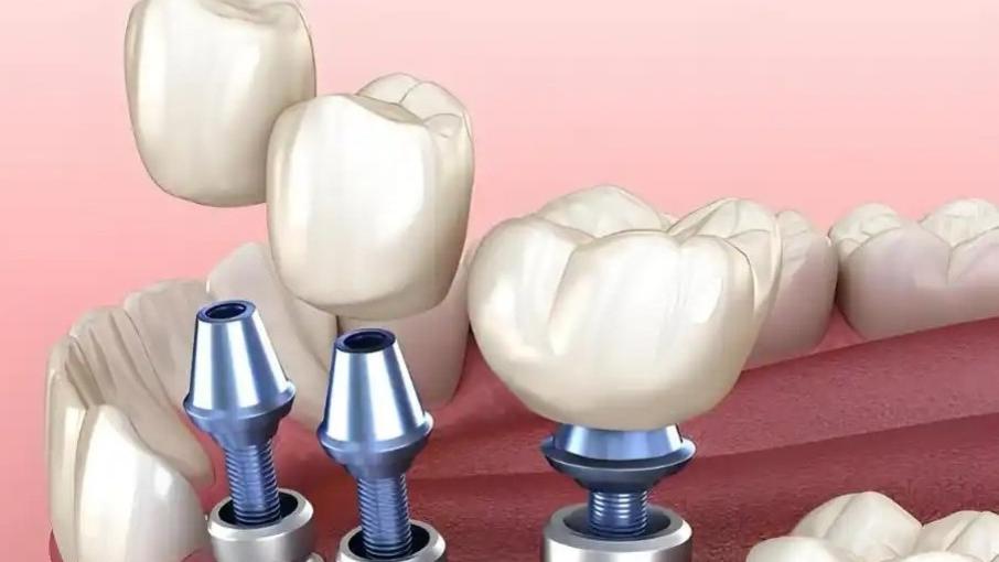 缺牙有哪些常见的补牙方式？—义乌牙齿修复