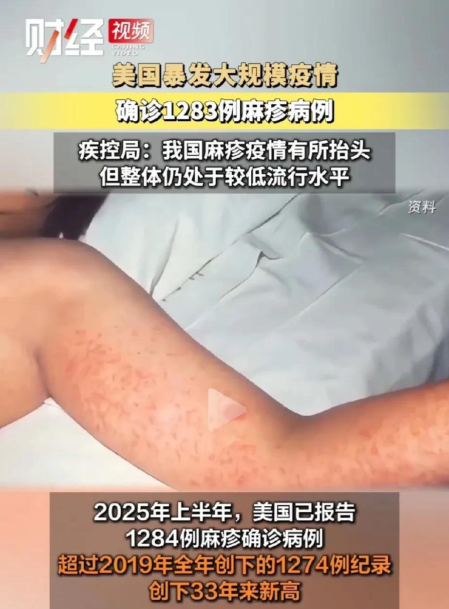 美国暴发麻疹疫情！
小孩子要注意了。
若是暴发麻风病就不好办了。
川普很邪门，上