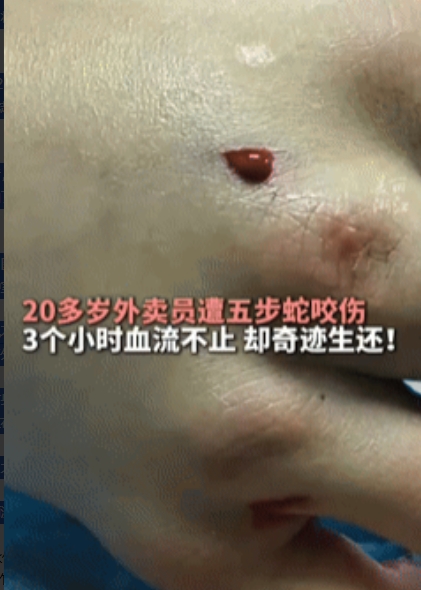 “命真大！”重庆巫溪，一20多岁外卖员回老家看望爷爷途中，不幸被五步蛇咬伤，3小