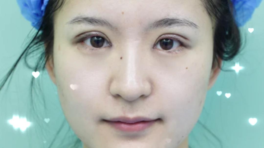 从臃肿到精致有多远？韩旭案例：脂肪眼蜕变全记录！