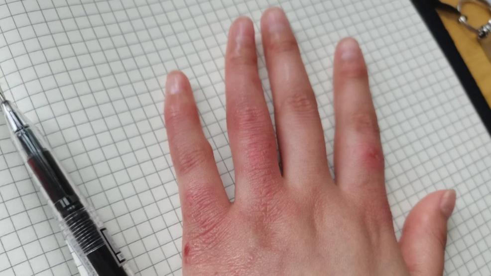 试了N种方法，终于找到了冻疮快速消肿止痒不反复的法子！速看！