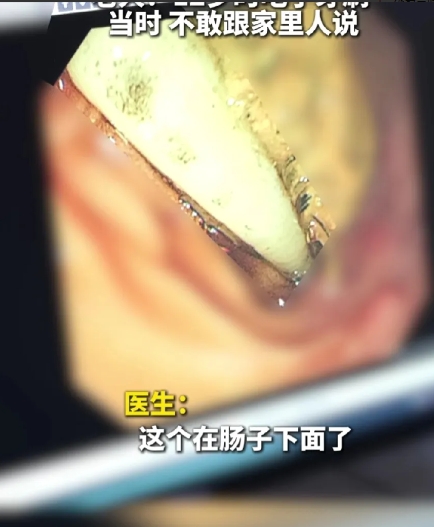 惊呆了！牙刷深藏老人体内，时隔52年被取出，这是一个真实事件。近日，安徽省全椒县