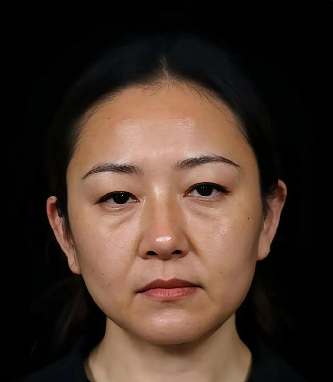 这个脸部提升做的非常成功
最起码足足年轻了二十岁都有吧