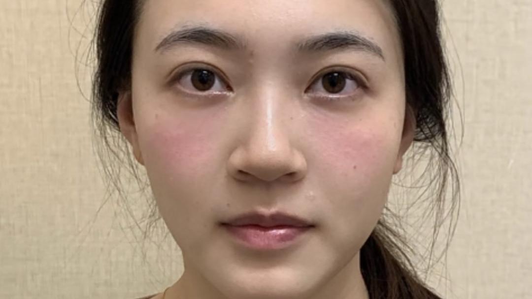 微调面部填充术后效果？真人案例：自然变美像长开！
