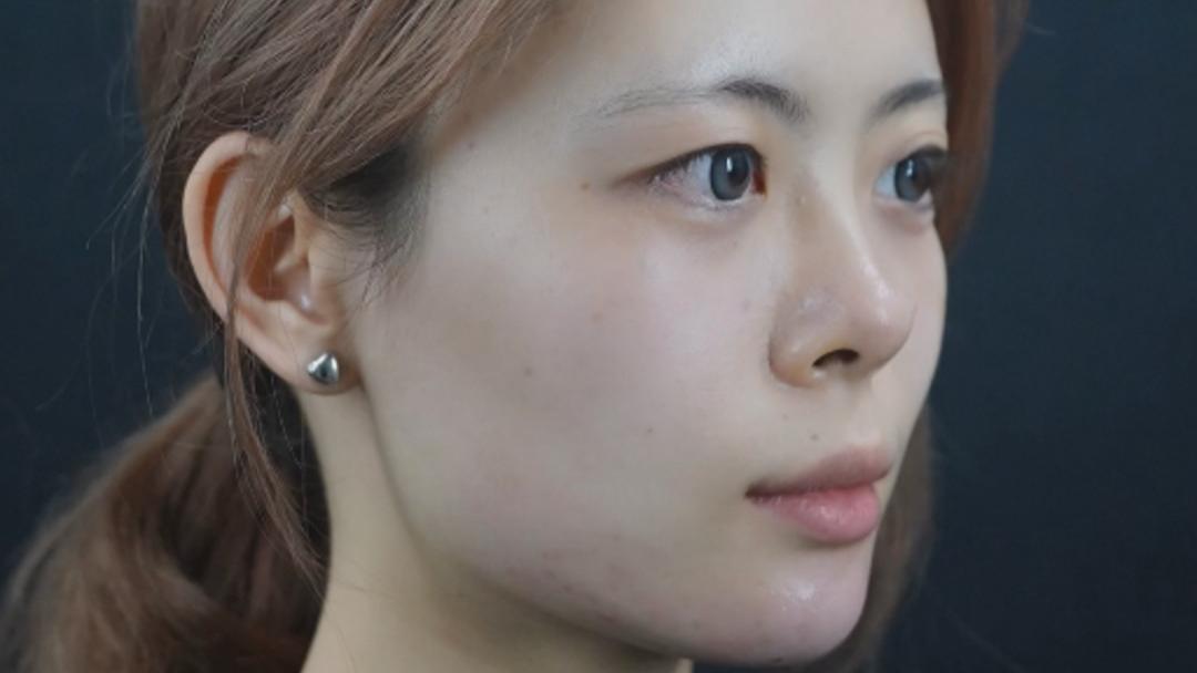 短下巴改变能多明显？真人案例：从后缩到翘颌的完美蜕变！