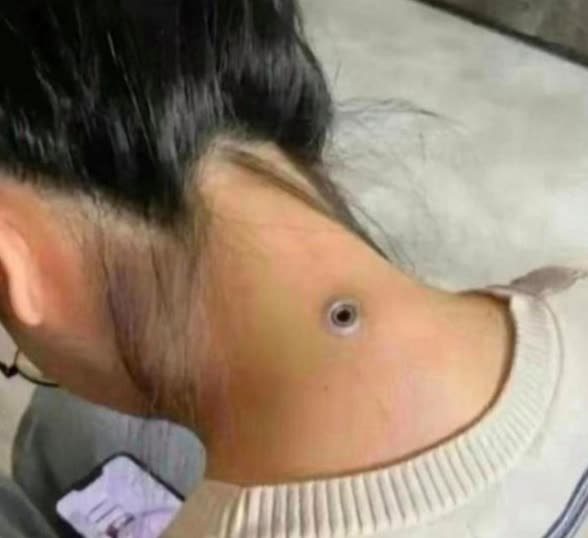 惊！朋友女友后颈现神秘孔洞