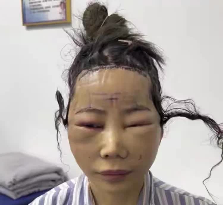 太美了？浙江杭州，有一名女子为了爱美，特意花了几十万到医院做医美，她隆了鼻子，开