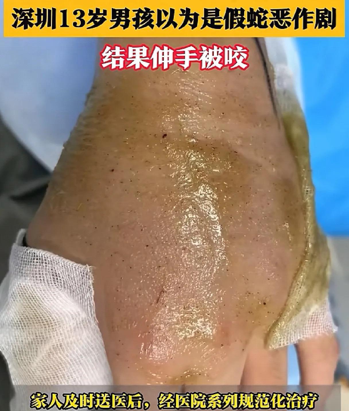 近日广东深圳，一条毒蛇缠在自行车上，13岁男孩以为是假蛇“恶作剧”，结果伸手被咬