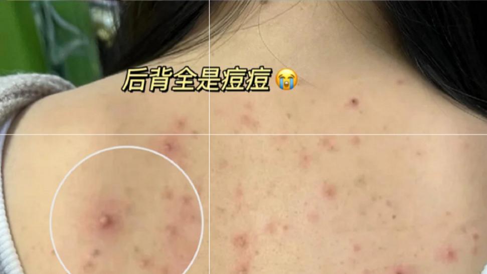 折磨我一年的后背痘痘终于没了！分享我的祛痘方法，看到就是赚到！