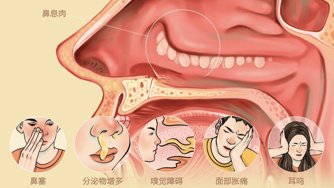 长了鼻腔鼻息肉，一定要手术吗？一篇文章为您解读！