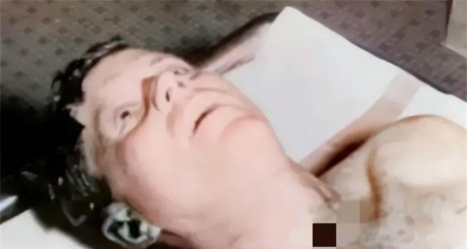 1963年，肯尼迪遇刺身亡，在为其进行尸检时拍下了这张照片。可以看到，肯尼迪身中