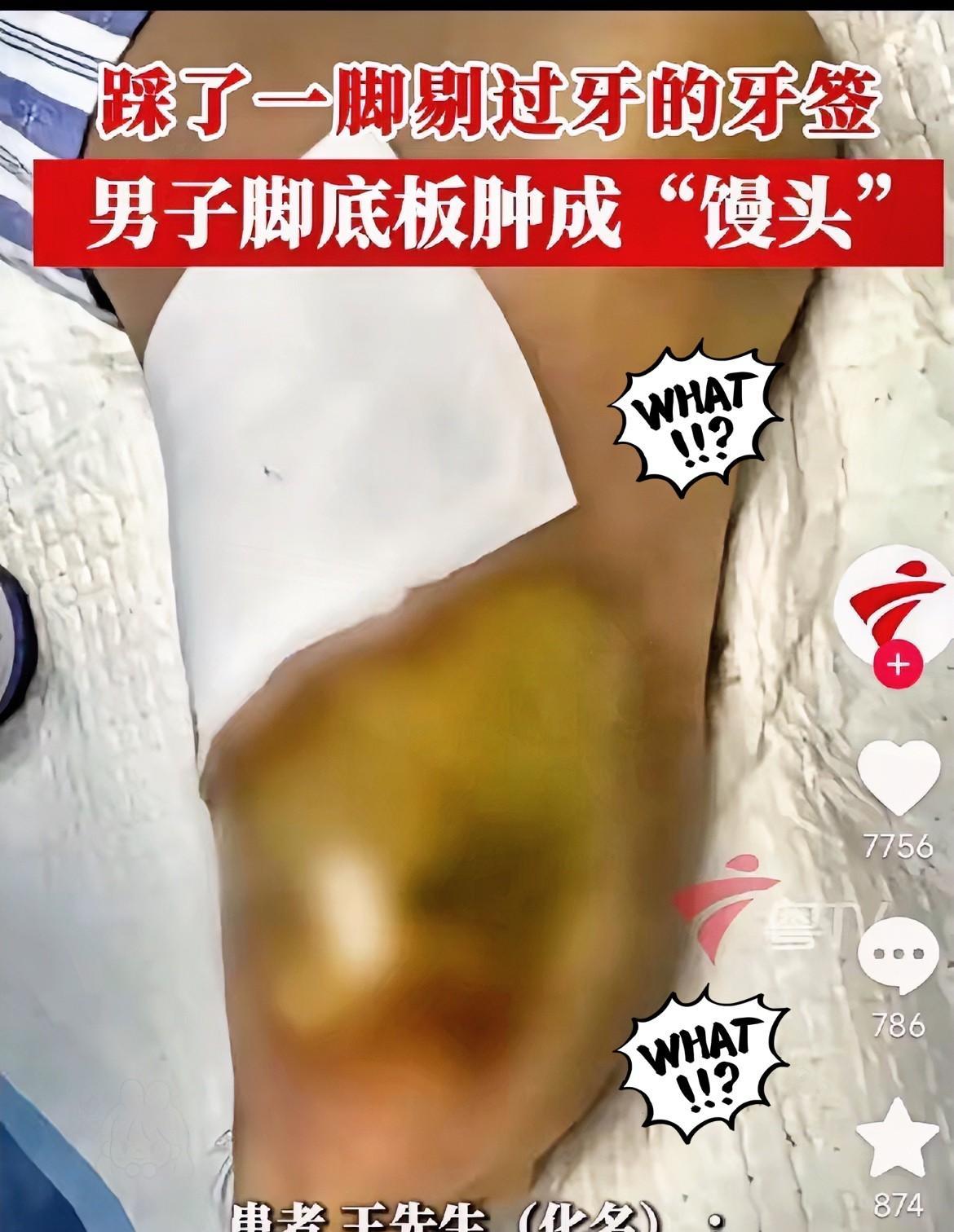 广东深圳发生一起悲剧，
男子饭后用牙签剔牙，不小心踩到掉在地上的牙签，伤口没处理