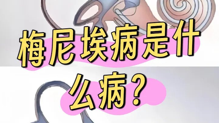 梅尼埃综合征可用此方治愈