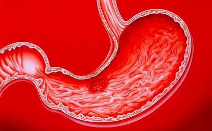 4个导致中青年人发生胃癌的生活习惯！
