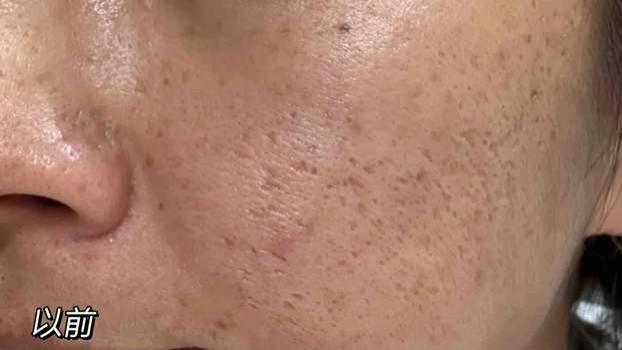 刷酸真的能收缩毛孔吗？