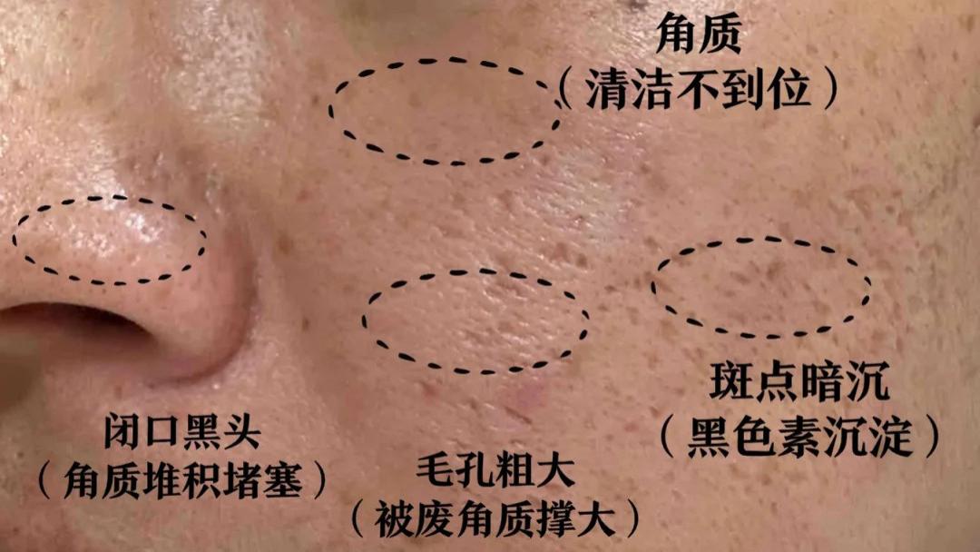 冬季怎么收缩毛孔？