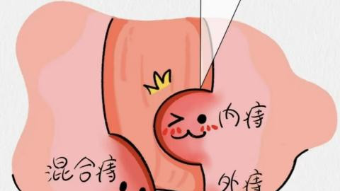 哪个牌子痔疮膏消肉球效果好？2025排行榜前六，痔疮党闭眼入