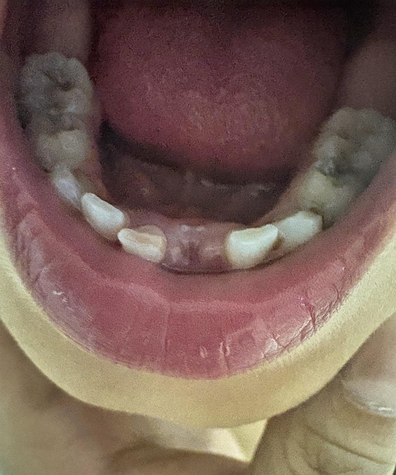 乳牙脱落了，但是没有从掉的地方长出恒牙，而是在里面长的，这可咋整？