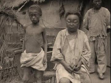 听说过饥饿使人消瘦，从来不知道原来饥饿还会导致人浮肿！

这是1920年代的大饥