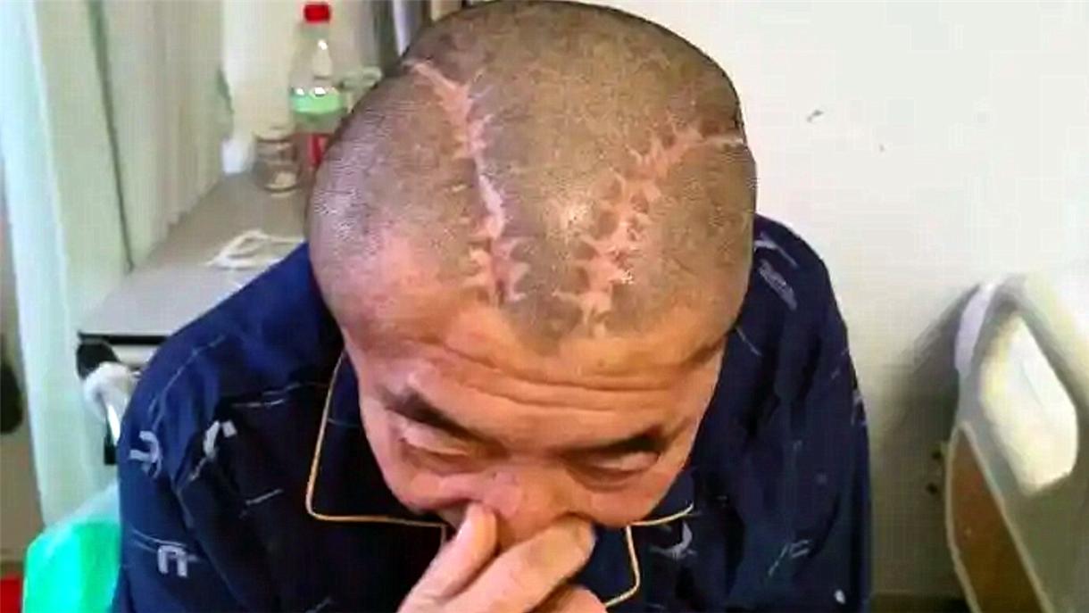 后续来了，男子有脑出血，结果医生手术时把左脑开颅了，医院一直在试图隐瞒