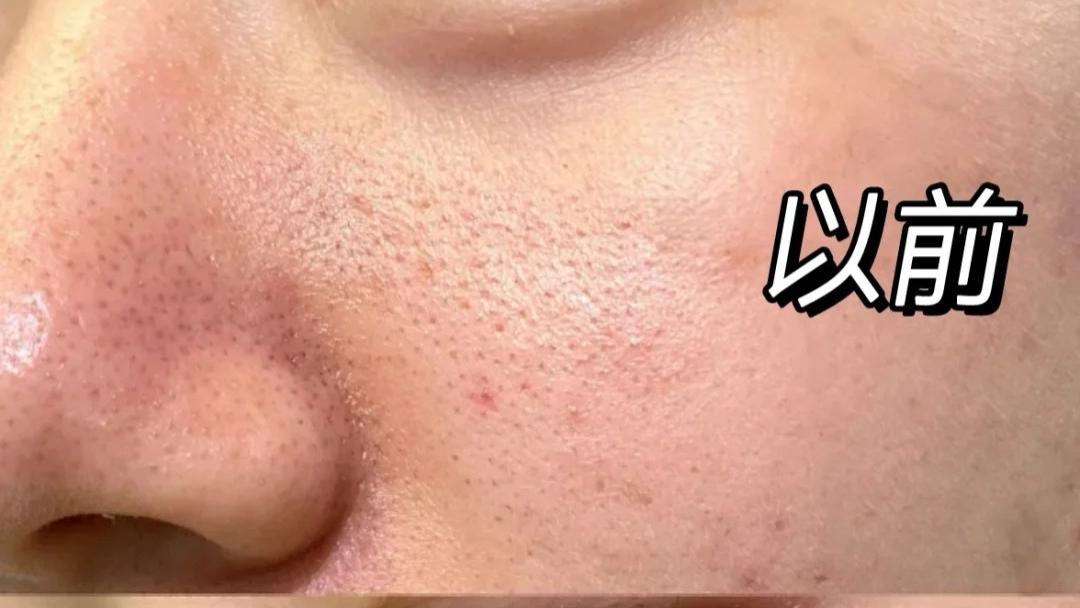 毛孔太大了怎么收缩