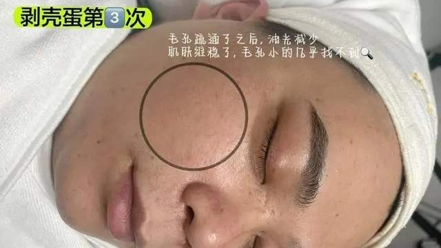 毛孔粗大怎么改善